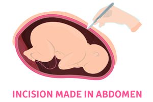 怀孕36周能剖腹产吗